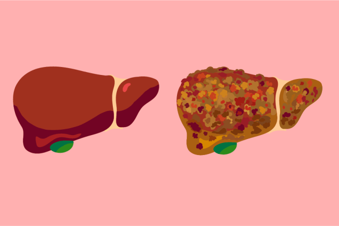 Graphic illustrations showing a healthy liver, and a spotted, diseased liver.