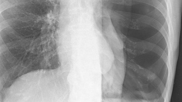 Chest X-ray showing pneumothorax