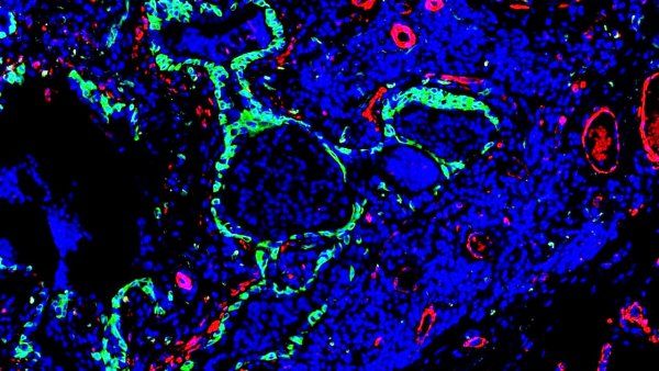 microscopic image shows gree stained abnomal stem cells near scar-forming fibroblasts