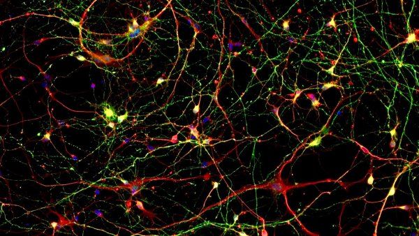 microscopic image of neurons and accumulation of phosphorylated tau protein