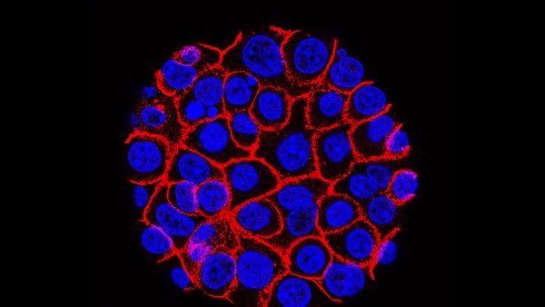 microscopic image of pancreatic cancer cells