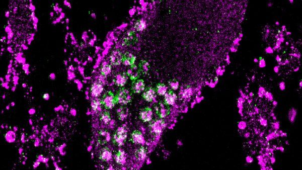 Microscopic image showing accumulation of lipids in lysosomes