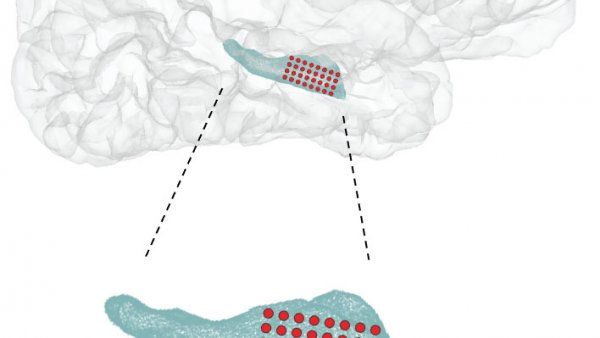 Illustration showing location of hippocampus and electrode during surgery