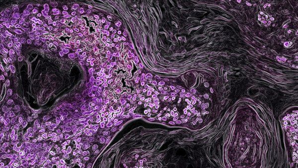 microscopic image of Kras-driven lung cancer in a mouse model