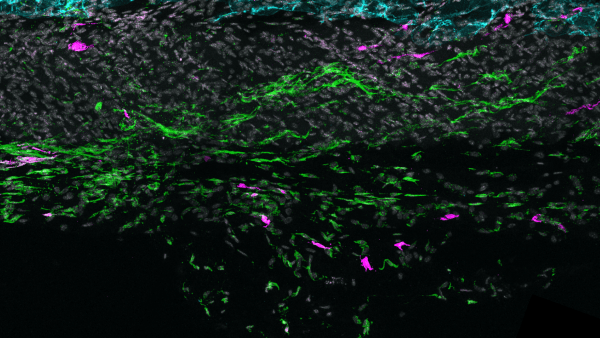 Microscope image of skin fascia showing TIFFs