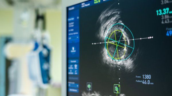 Intravascular ultrasound imaging (IVUS) at cardiac catheterization laboratory room