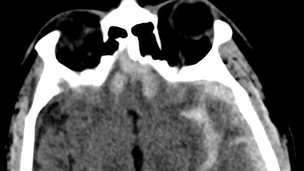 A CT scan of a brain that has suffered a traumatic brain injury