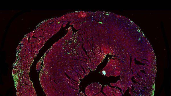 Microscopy of a mouse heart with immune infiltrates indicating ICI-myocarditis