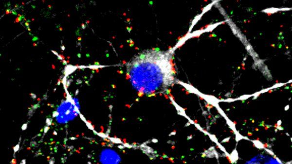 Microscopy of white connections between blue glioblastoma cells.