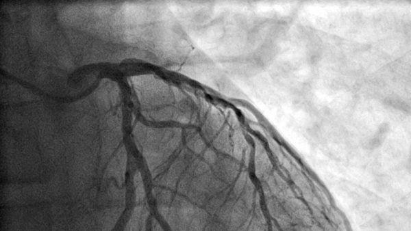 An angiogram showing the left coronary artery with its branches.