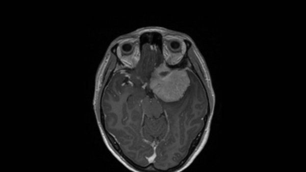 A top-view MRI scan of a brain with a tumor on the right side of the brain.