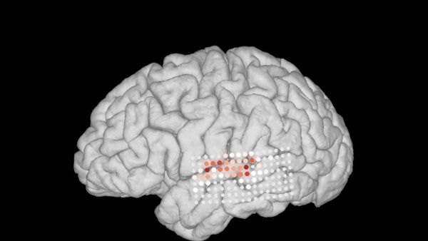 A scan of a brain showing activity in the auditory cortex during speech and music.