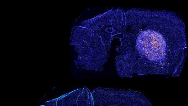 A series of three brain scans showing T-cells attacking a glioblastoma over time. The third scan shows dying glioblastoma cells.