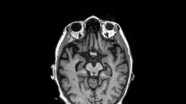 A brain scan showing the presence of progressive supranuclear palsy.