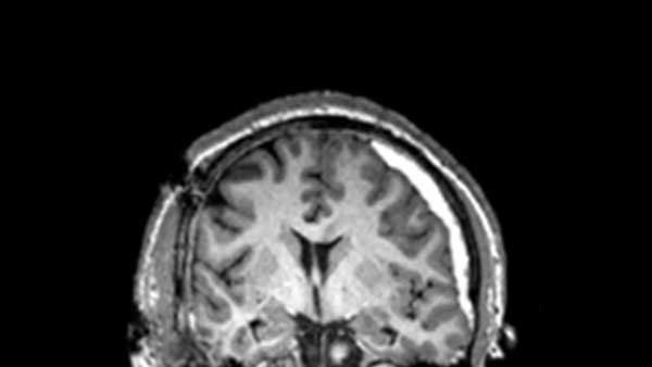 An MRI image of a back view of a brain with a traumatic injury.