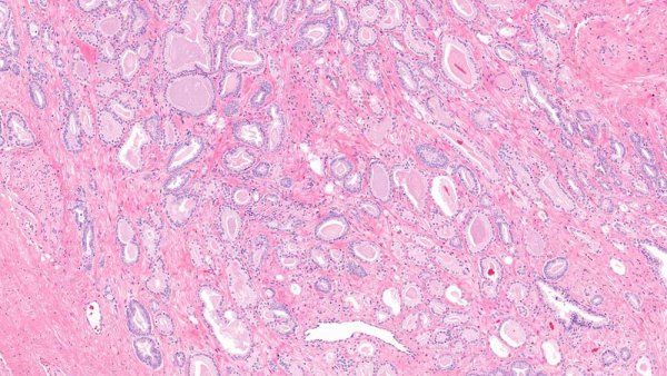 A microscopic image showing small levels of carcinoma in prostate tissue.