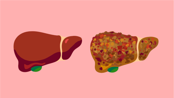 Graphic illustrations showing a healthy liver, and a spotted, diseased liver.