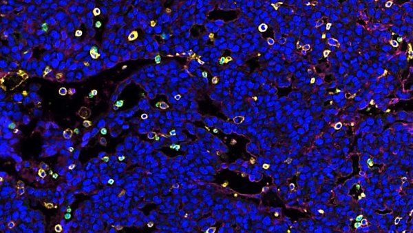Microscopic image showing tumor tissue that lacks lymphocytes.