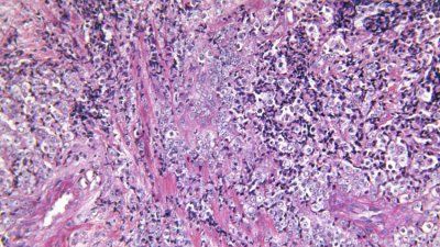 Prostate Gland Adenocarcinoma.jpg