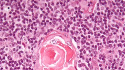 Thymic_corpuscle_Wikimedia_commons.jpg