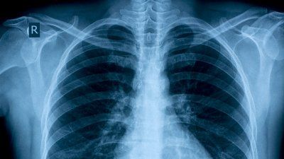 chest_x-ray.jpg