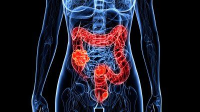 colon-cancer-illustration.jpg