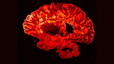 MS_Brain_Lesions.jpg