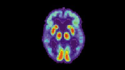 PET_Alzheimer.jpg