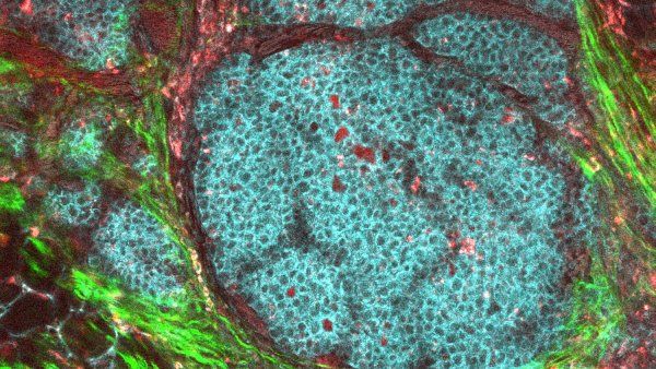 A breast cancer tumor
