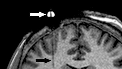 catheter_brain_MRI_Gene_editing.jpg