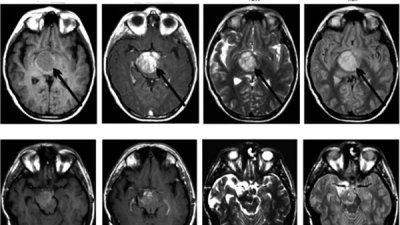 diffuse_intrinsic_pontine_glioma_scan.jpg