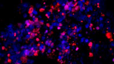 metastatic_prostate_cancer_cells_killed_by_ISRIB_red.jpg